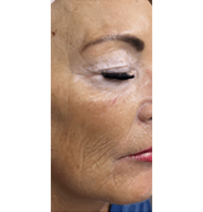 Microneedling, PRP, Retinol