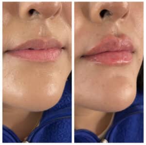 before and after lip fillers by katrina at third eye beauty lounge in tempe az