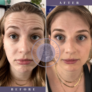 before & after botox by katrina at third eye beauty lounge in tempe az